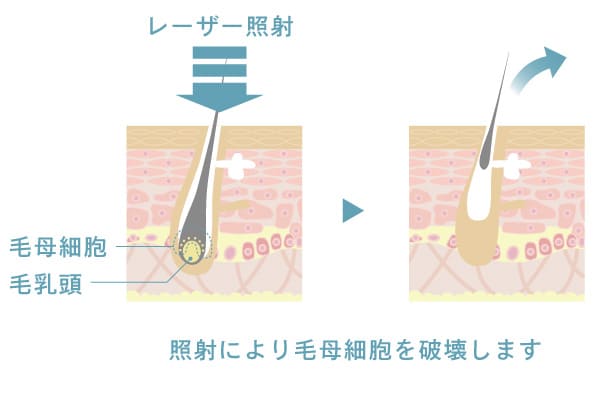 照射により毛母細胞を破壊します