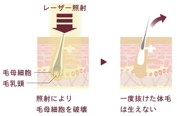 ミセルクリニックの医療レーザーの仕組み断面図。照射により毛母細胞を破壊。一度抜けた体毛は生えない。
