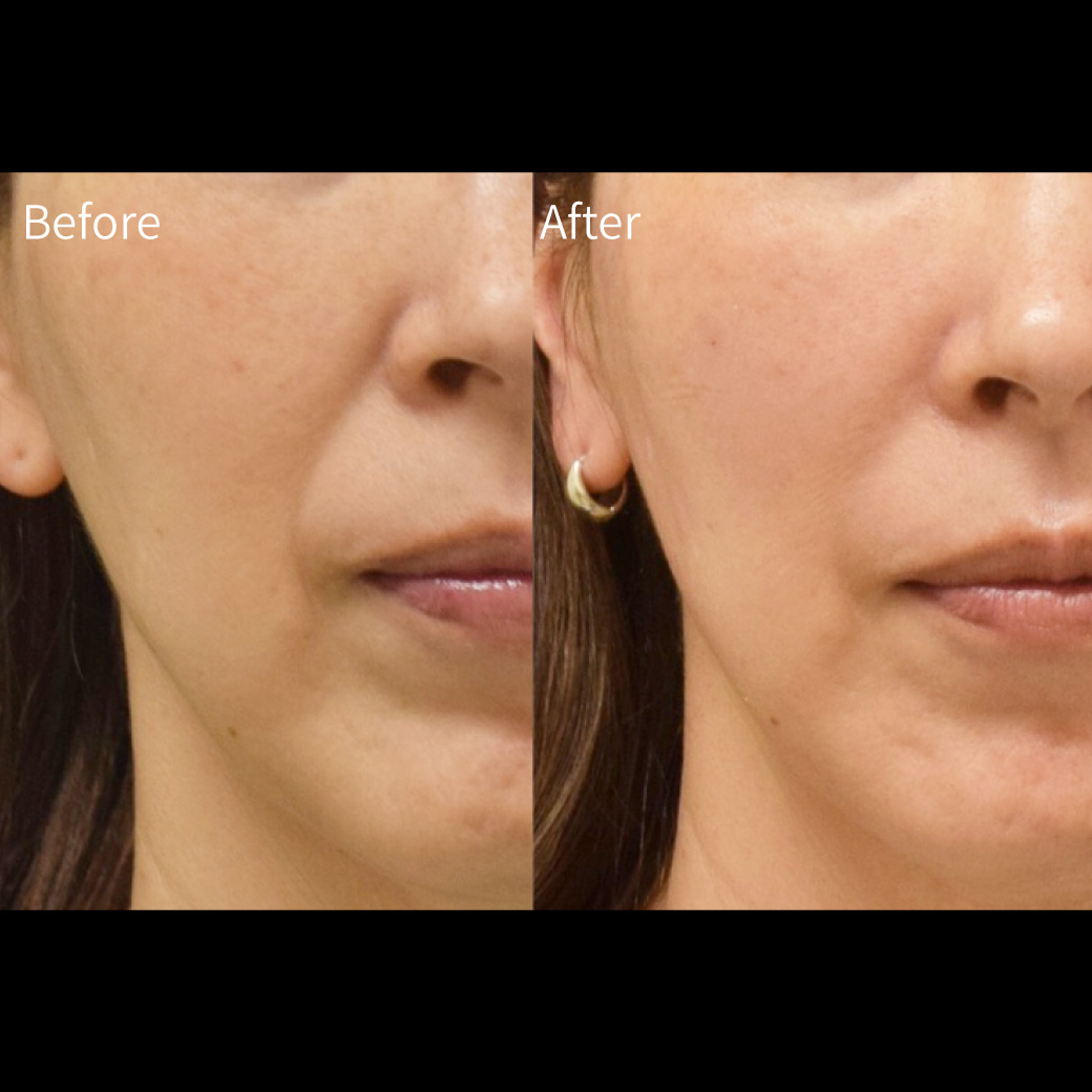 ヒアルロン酸の症例画像