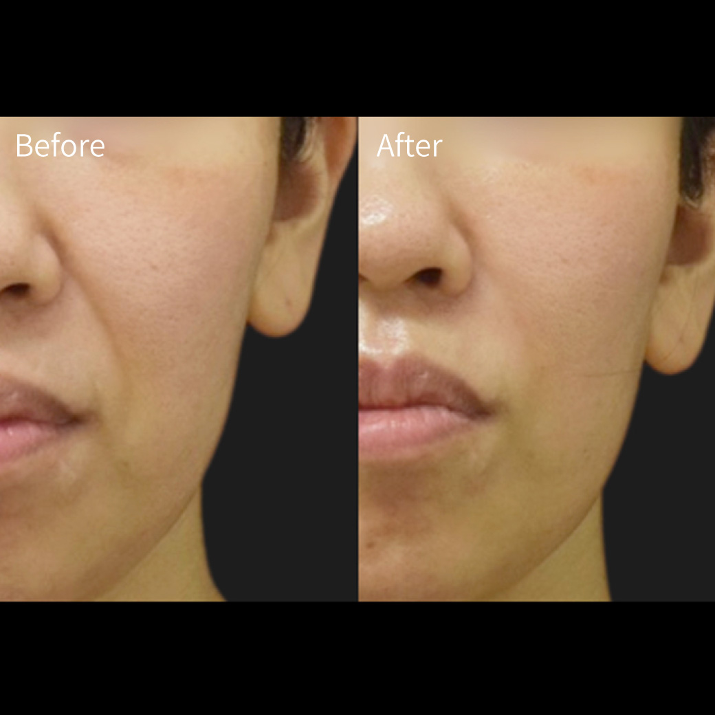 ヒアルロン酸の症例画像