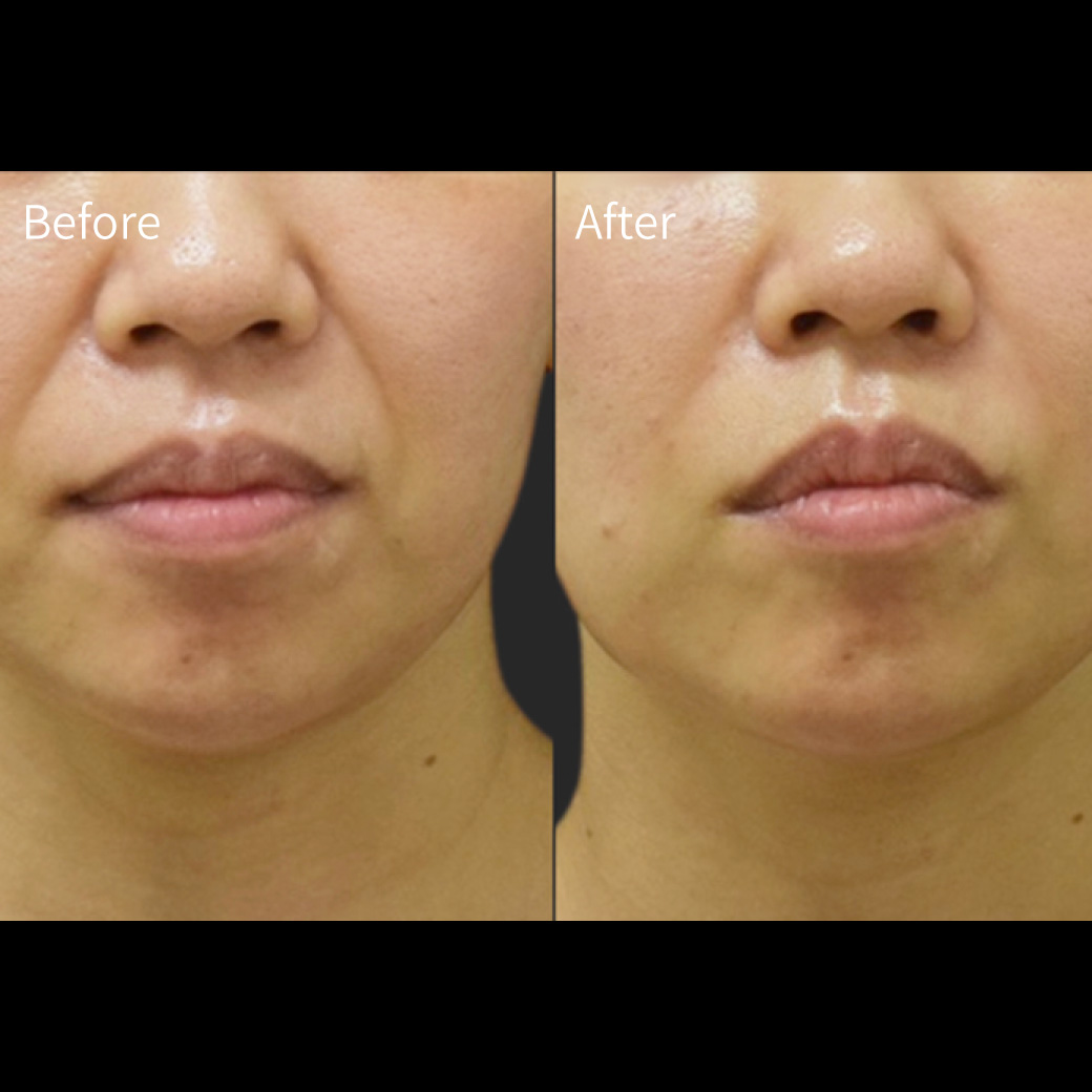 ヒアルロン酸の症例画像