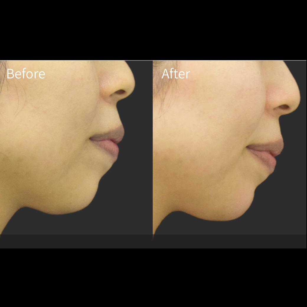 ヒアルロン酸の症例画像